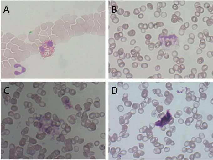 Figur 2: Eksempler på artefakter som kan oppfattes som trombocyttaggregater i blodutstryk; ødelagt eosinofil granulocytt (A), kjerneskygge (B) og fargeutfellinger (C og D).
